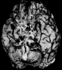 Subarachnoid hemorrhage, base of brain